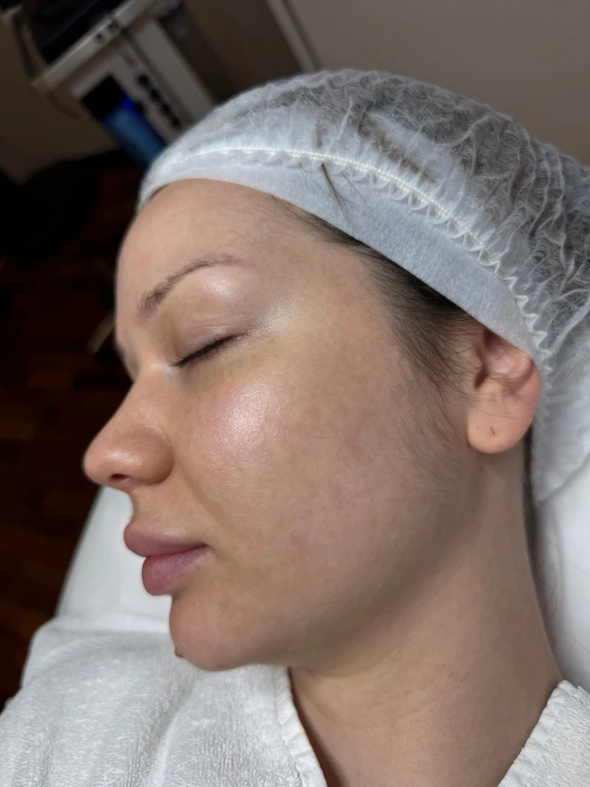 acne-skin-after