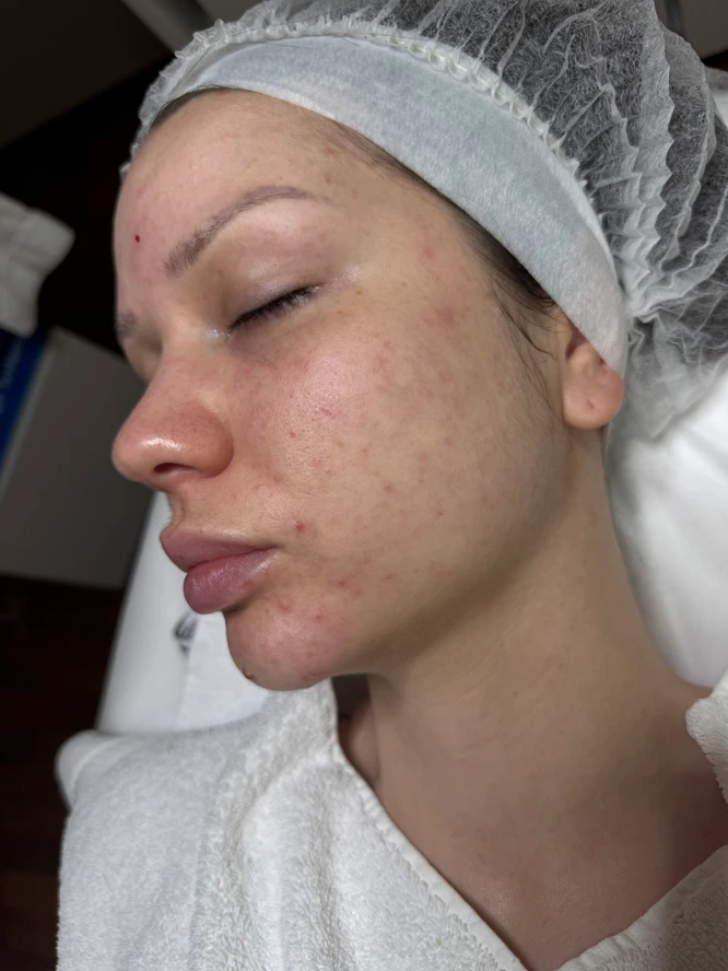 acne-skin-before