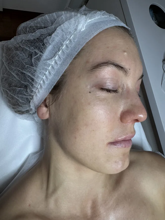 eczema-prone-skin-after