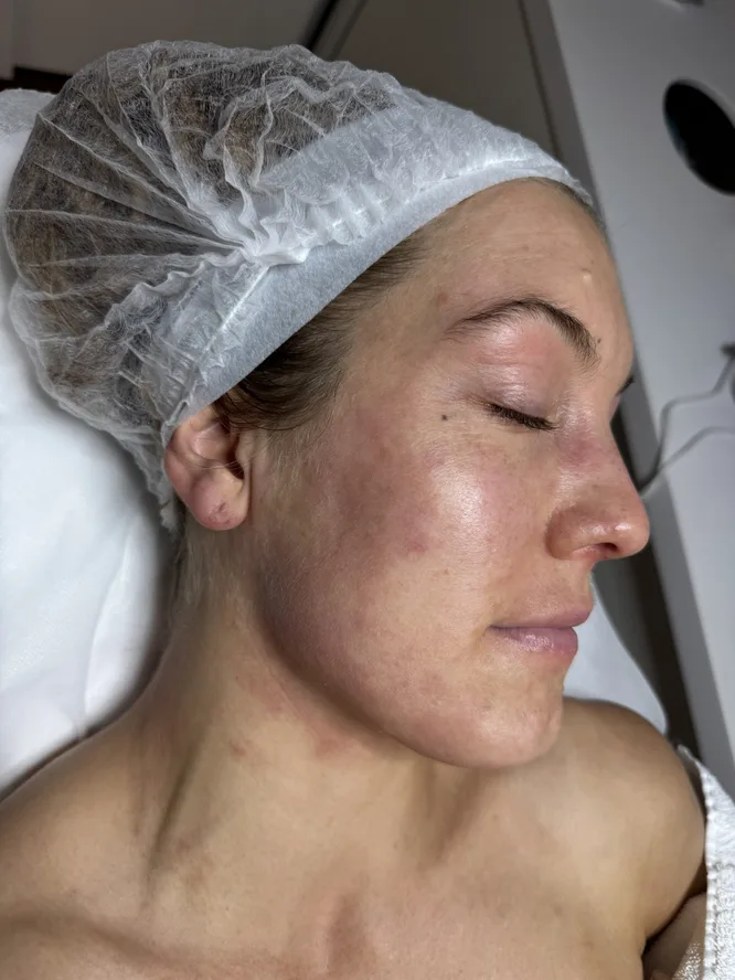 eczema-prone-skin-before