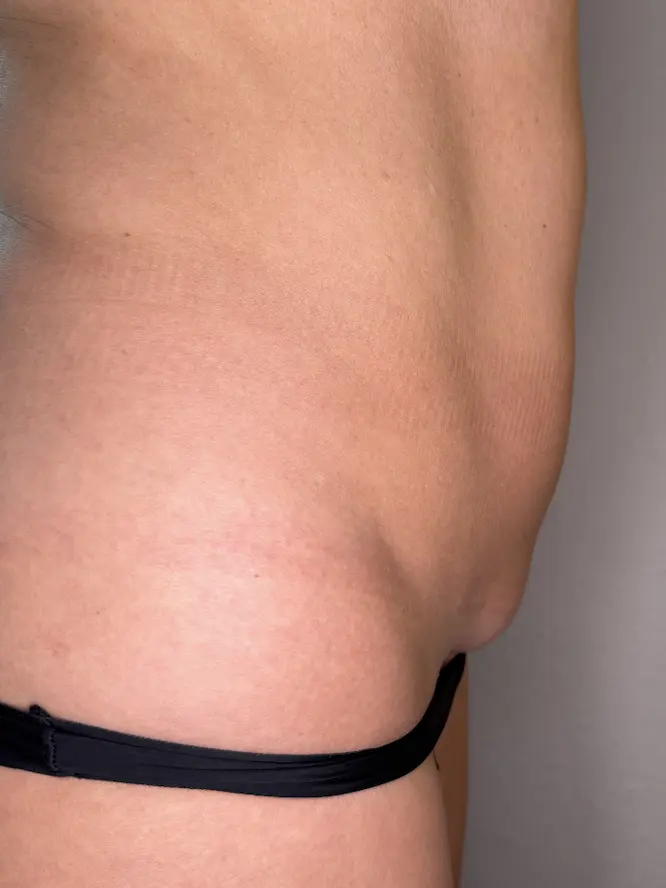 body_contouring_after