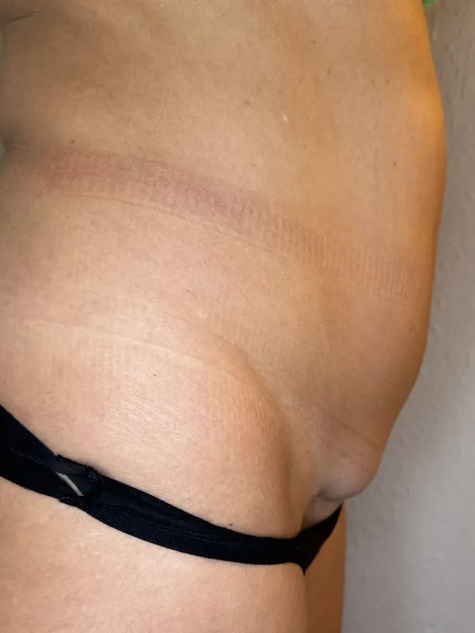 body_contouring_before