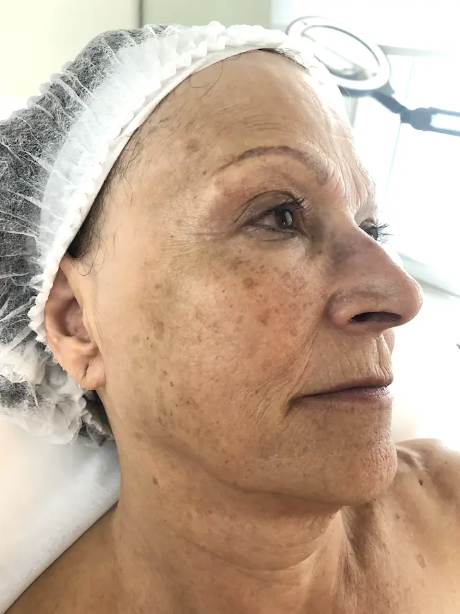 pigmentation-after