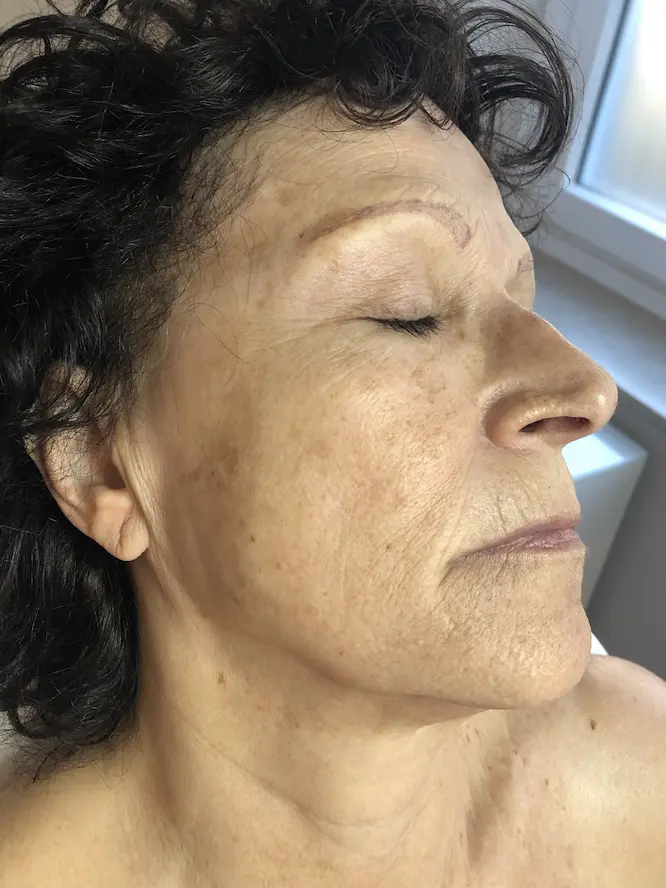 pigmentation-before